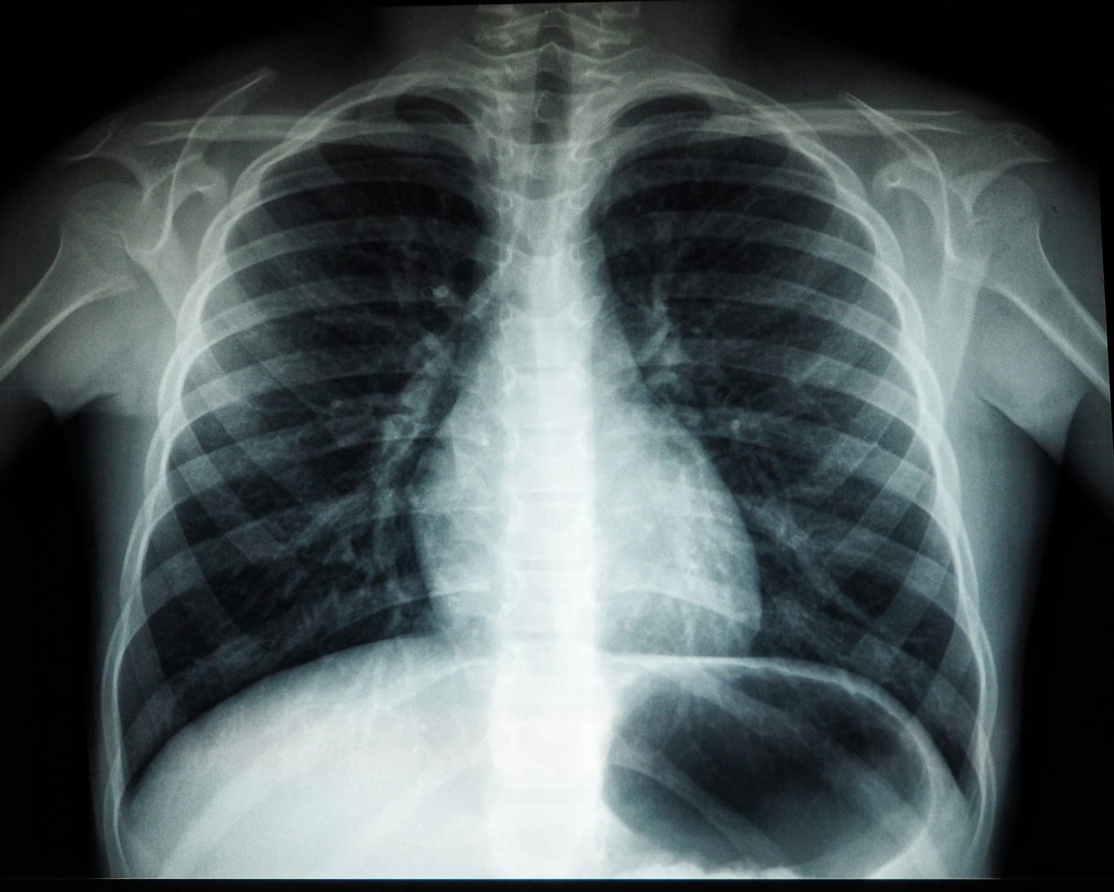 Une radiographie du thorax montrant les côtes, les poumons et l’ombre du cœur